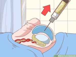 हाइड्रोसील का इलाज