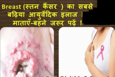 स्तन कैंसर Breast Cancer के घरेलू इलाज और उपाय in Hindi