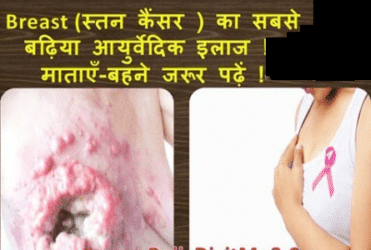 स्तन कैंसर (Breast Cancer) के घरेलू इलाज और उपाय in Hindi