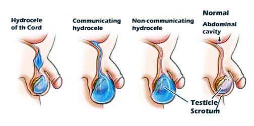 Hydroceles-Hernias-हाइड्रोसील कैसे होता है