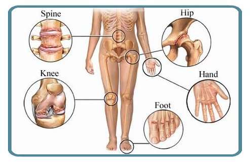 गठिया क्या है ? गठिया रोग का इलाज और घरेलू उपचार Arthritis Treatment in Hindi गठिया रोग क्या है